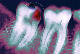 Cavity seen on an x-ray.: image via webMD.com