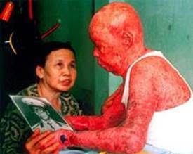 A Vietmnamese victim of Agent Orange, dramatically demonstrating one of the dermatological expressions of the disease.