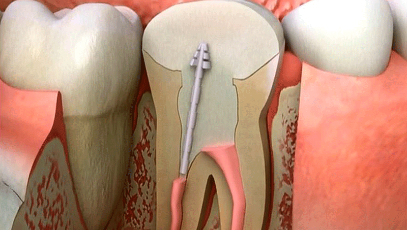rootcanal
