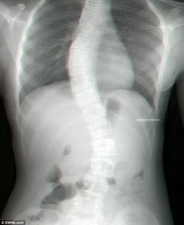 X-Ray of Rebecca's spine before her treatment. For nearly a decade she wore clothes more than four sizes too big as she became embarrassed and ashamed about her deformity